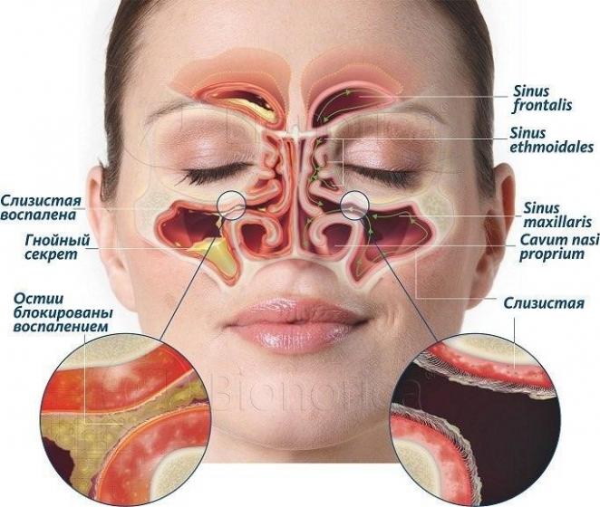 Синусит носа
